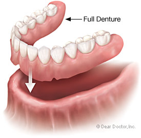 full denture